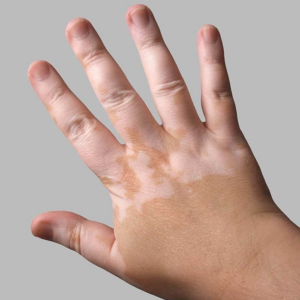 Vitiligo na prstoch